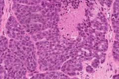 Basaloid squamous cell carcinoma of the larynx