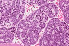 Basaloid squamous cell carcinoma of the larynx