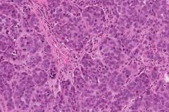 Basaloid squamous cell carcinoma of the larynx