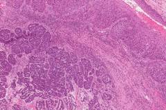 Basaloid squamous cell carcinoma of the larynx