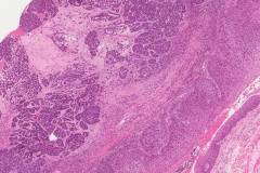 Basaloid squamous cell carcinoma of the larynx