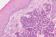 Basaloid squamous cell carcinoma of the larynx