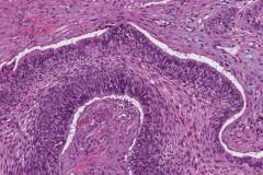 Squamous cell carcinoma of the larynx with basaloid features