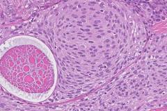 Benign Brenner tumour of the ovary