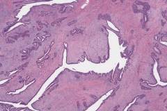 Benign phyllodes tumour of the breast