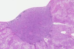 Bile duct adenoma of the liver