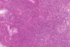 Biphenotypic sinonasal sarcoma