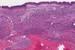 Biphenotypic sinonasal sarcoma