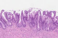 Borderline mucinous tumour of the ovary