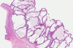 Borderline mucinous tumour of the ovary