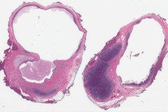 Branchial cleft cyst