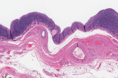 Branchial cleft cyst