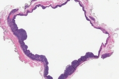 Branchial cleft cyst