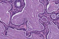 Bronchiolar adenoma of the lung