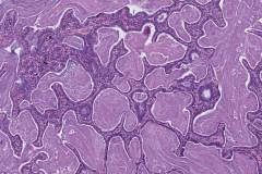 Bronchiolar adenoma of the lung