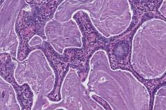 Bronchiolar adenoma of the lung