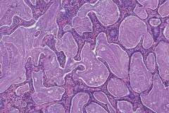 Bronchiolar adenoma of the lung