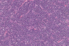 Burkitt lymphoma of the small intestine