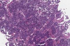 Burkitt lymphoma: Liver biopsy