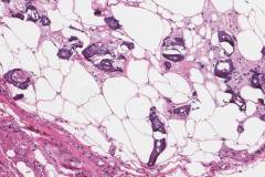 Calciphylaxis in subcutaneous adipose tissue