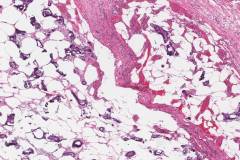 Calciphylaxis in subcutaneous adipose tissue