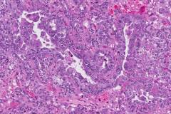 Carcinosarcoma of the uterus