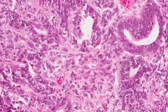 Carcinosarcoma of the uterus