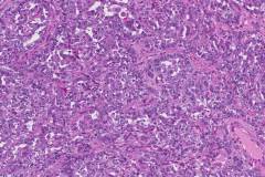 Carcinosarcoma of the uterus