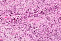 Carcinosarcoma of the uterus