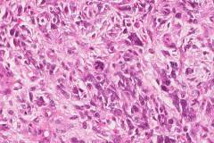 Carcinosarcoma of the uterus