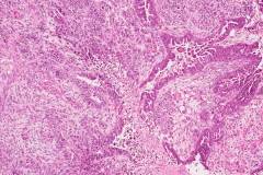 Carcinosarcoma of the uterus