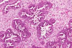 Carcinosarcoma of the uterus