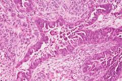 Carcinosarcoma of the uterus