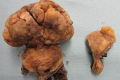 Carcinosarcoma of the uterus