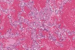 Cavernous hemangioma in the liver