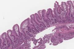 Villous blunting in a patient with celiac disease