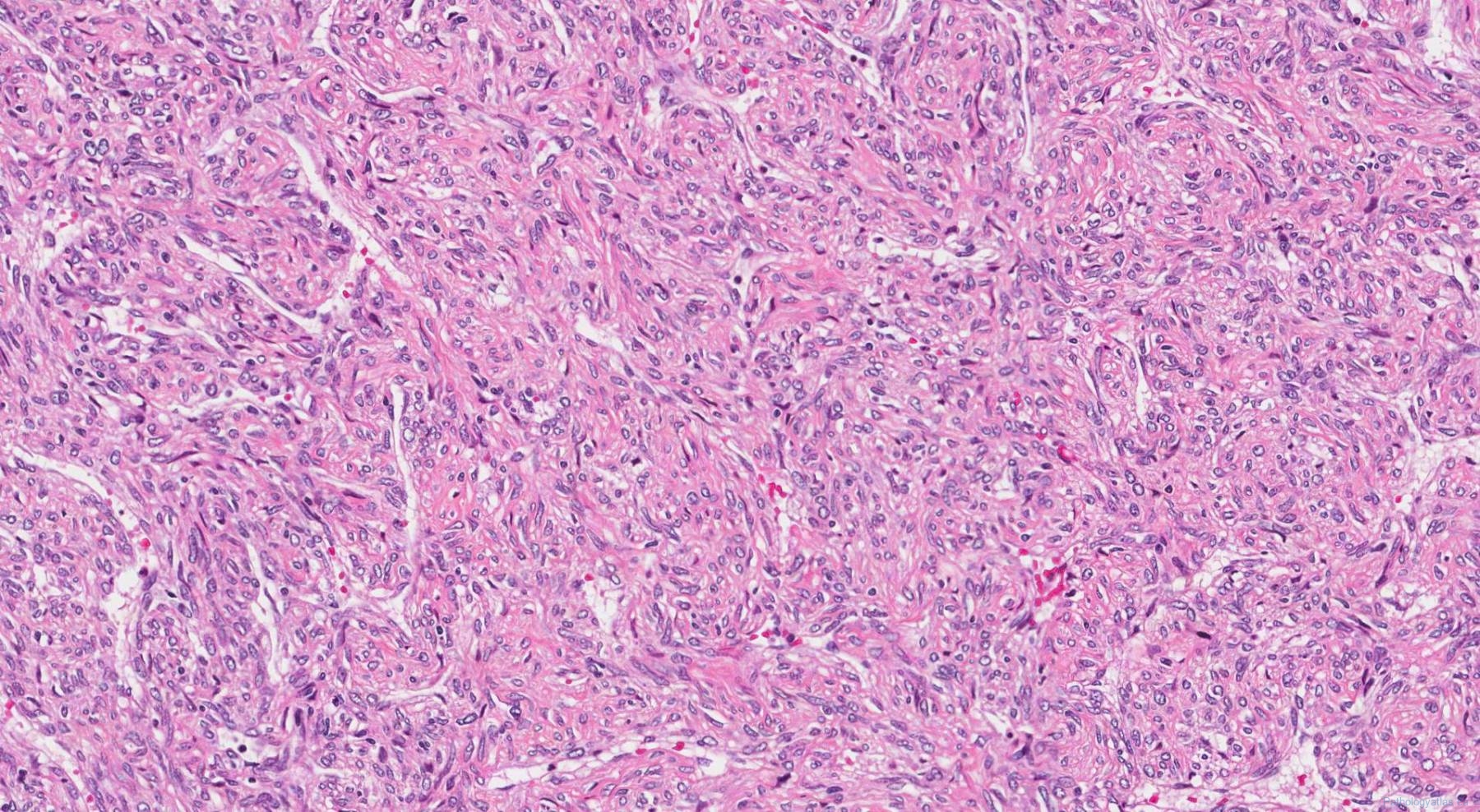 Central nervous system | Atlas of Pathology