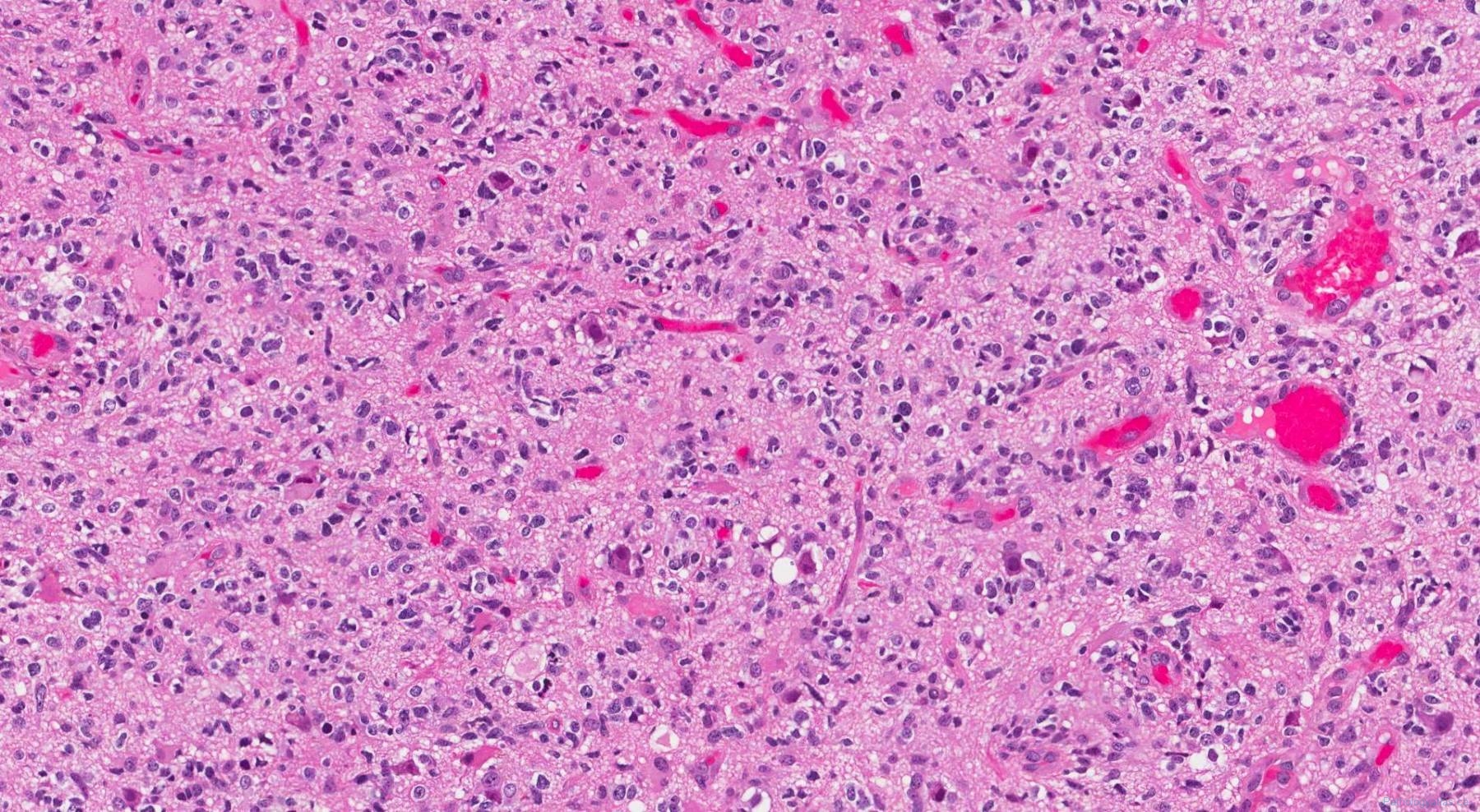 Central nervous system | Atlas of Pathology