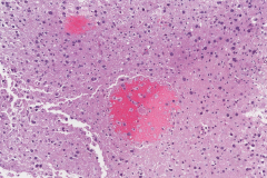 Progressive multifocal leukoencephalopathy