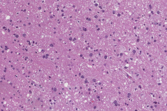 Progressive multifocal leukoencephalopathy