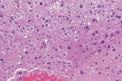 Progressive multifocal leukoencephalopathy