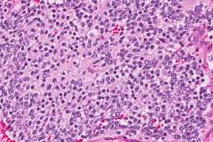 Poorly differentiated neuroblastoma