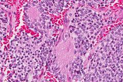 Poorly differentiated neuroblastoma