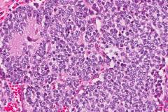 Poorly differentiated neuroblastoma