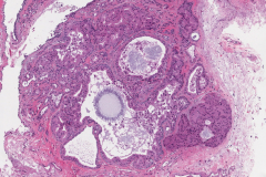 Ceruminous adenoma