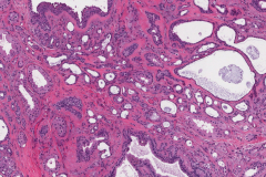 Ceruminous adenoma