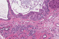 Ceruminous adenoma