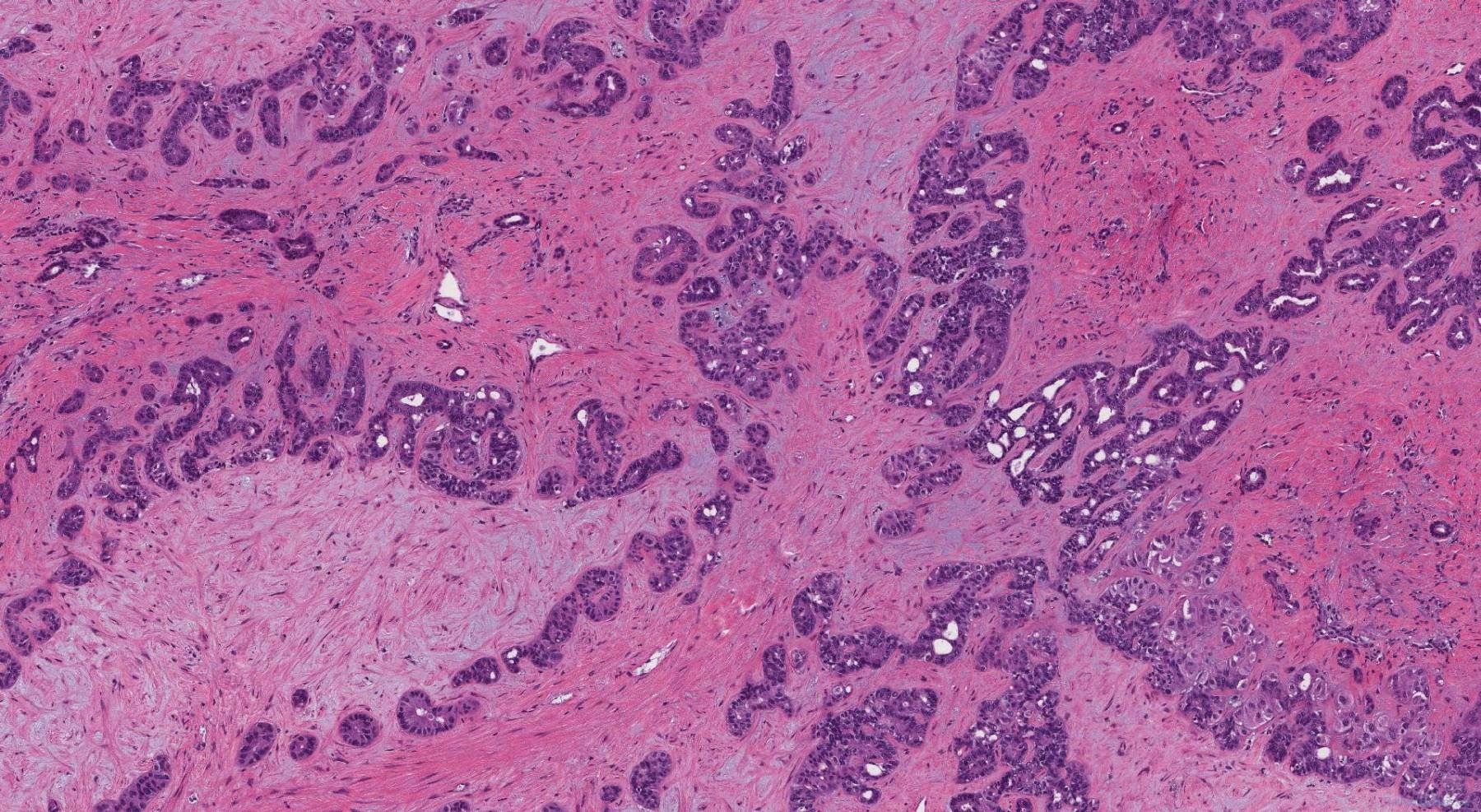 Cholangiocarcinoma | Atlas of Pathology