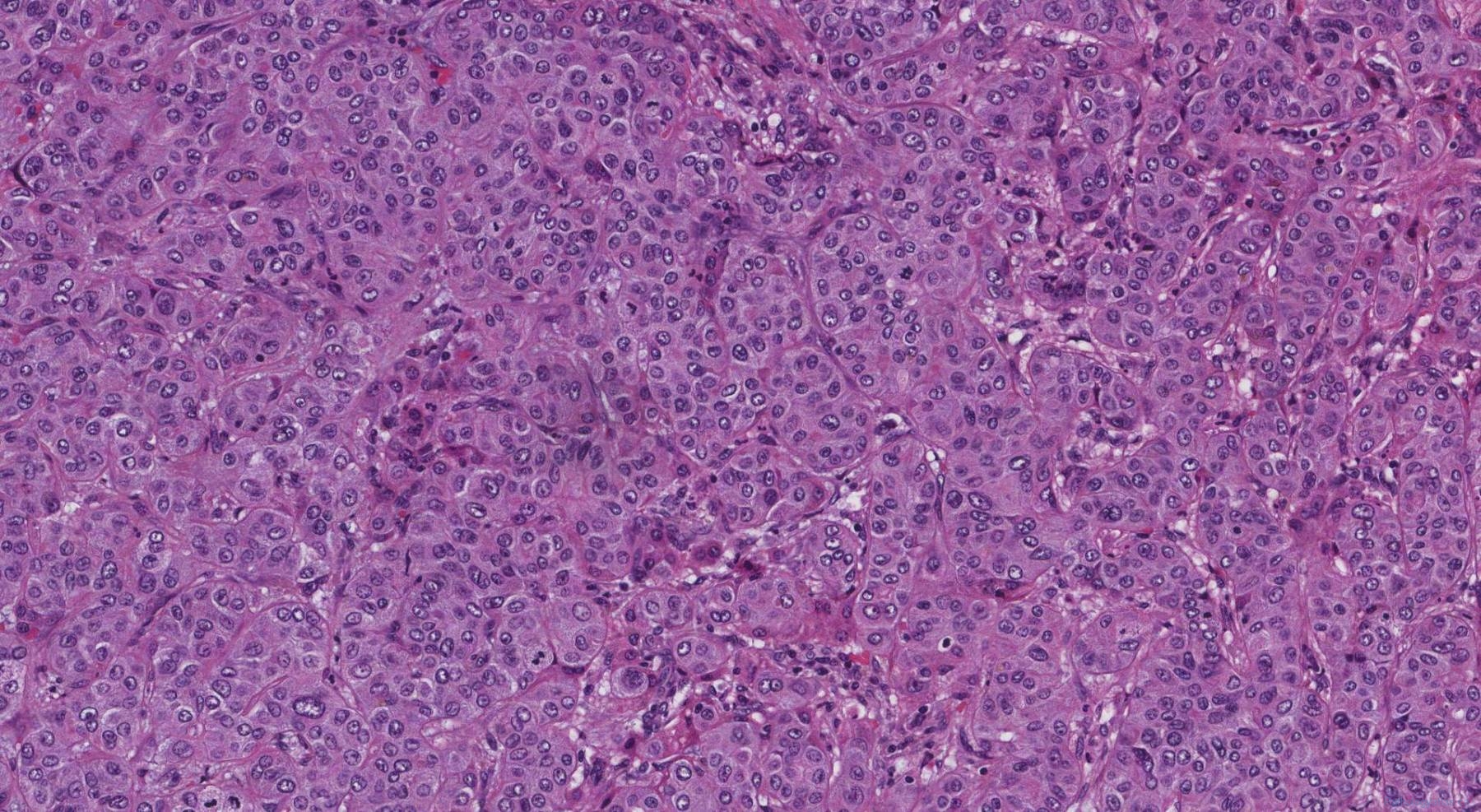 Cholangiocarcinoma | Atlas of Pathology