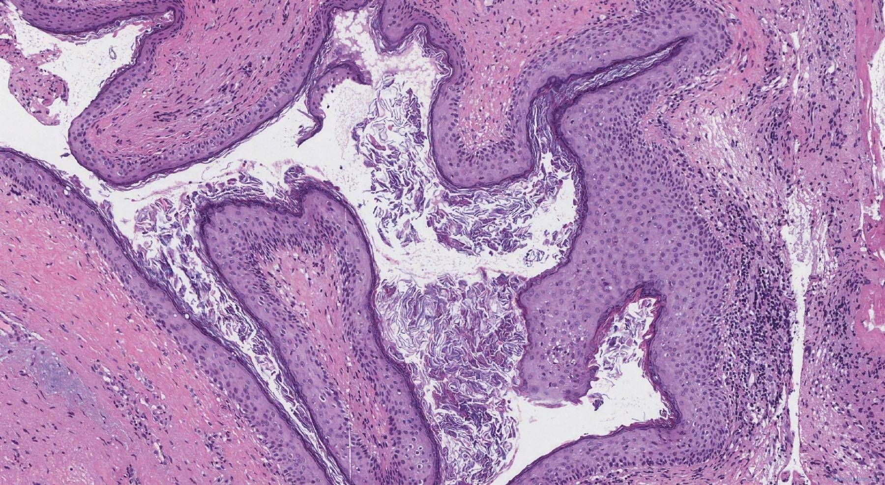 Cholesteatoma | Atlas of Pathology